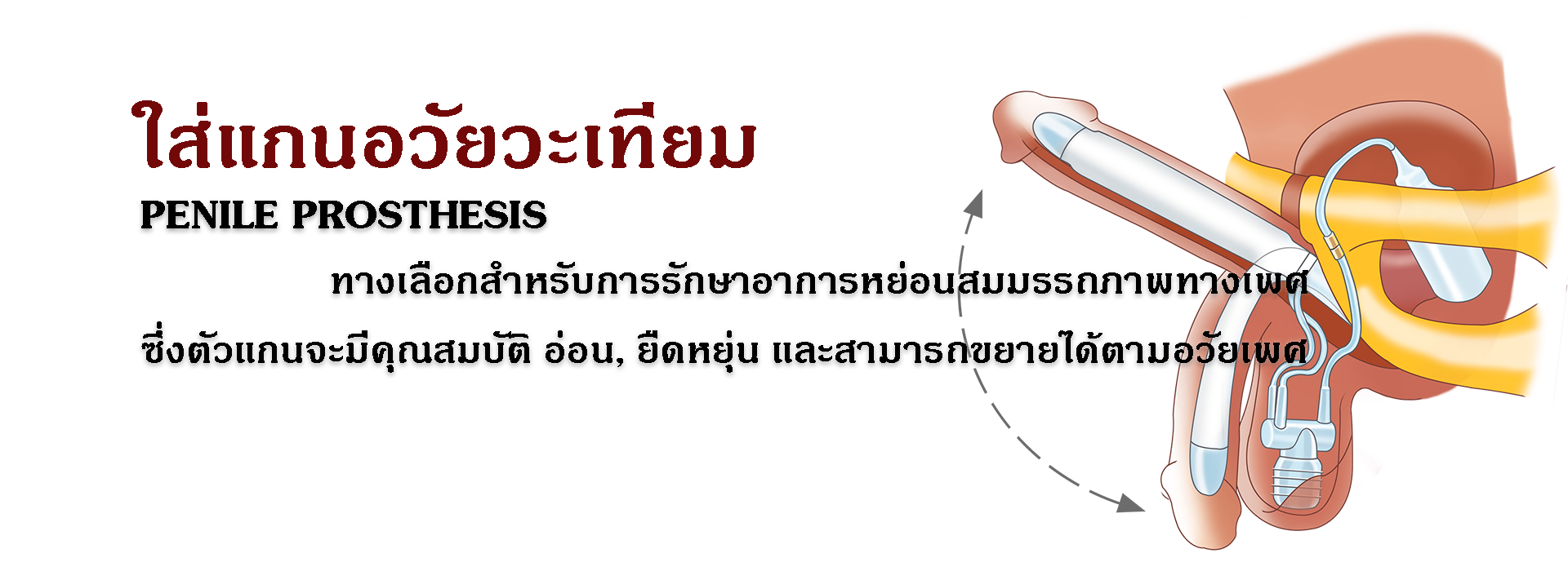 05 - ETERNITY CLINIC นพ.สืบพงษ์ เอ่งฉ้วน เเกนองคชาต แกนองคชาตเทียม ประเภทของแกนองคชาตเทียม