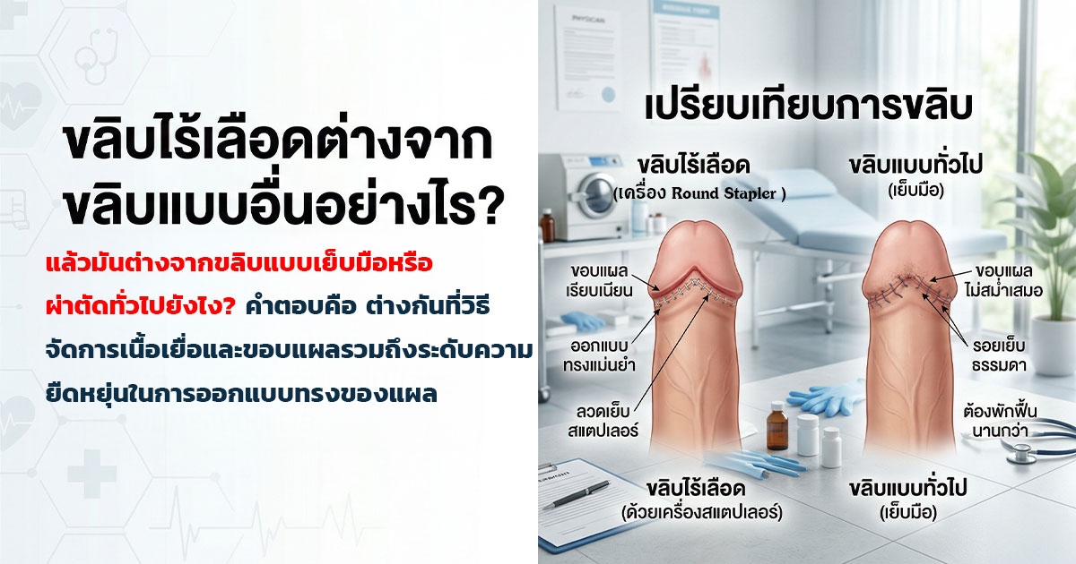 เปรียบเทียบขลิบไร้เลือดกับขลิบแบบเย็บมือ