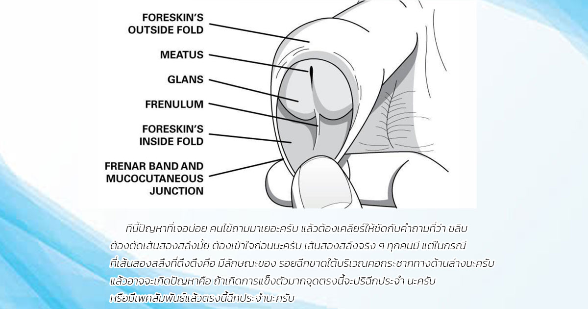 ขลิบหนังหุ้มปลาย และการประเมินร่วมกับเส้นสองสลึงตึง