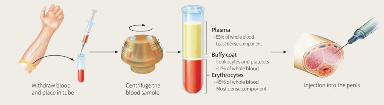 p-shot - ETERNITY CLINIC นพ.สืบพงษ์ เอ่งฉ้วน ฉีด p shot