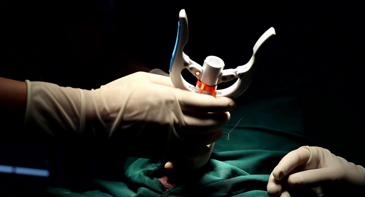 อุปกรณ์ขลิบไร้เลือด (รุ่นไทเทเนียม) แบบ disposable