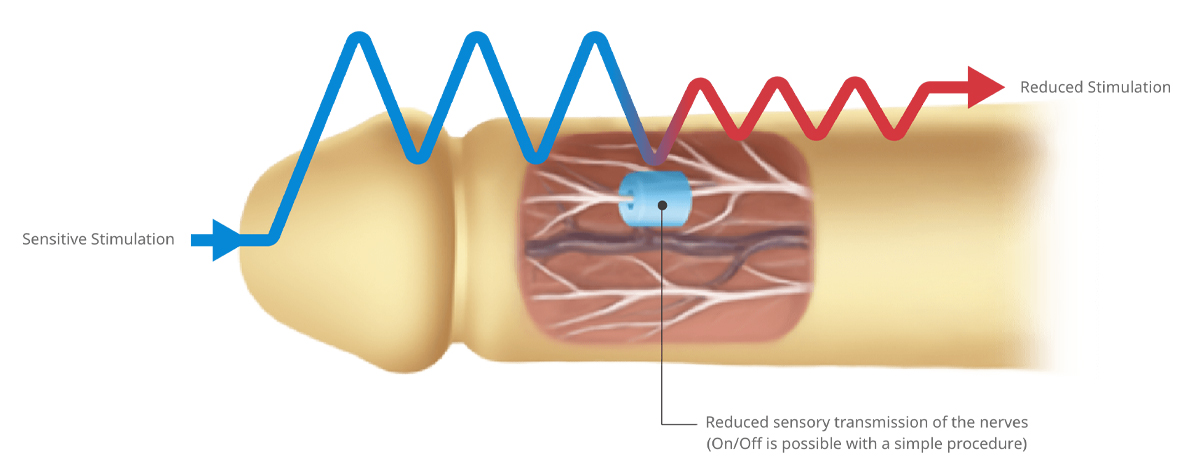 Dorsal Neurotomy - ETERNITY CLINIC นพ.สืบพงษ์ เอ่งฉ้วน ผ่าตัดแก้หลั่งเร็ว เป็นการผ่าตัดเส้นประสาทเพื่อแก้ปัญหาหลั่งเร็ว