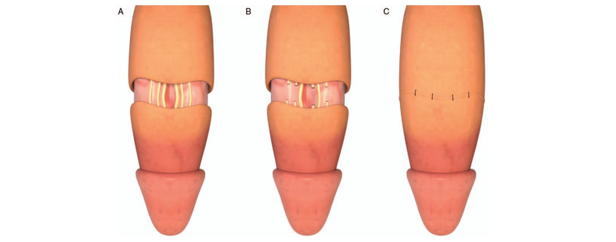 Dorsal Neurotomy2 - ETERNITY CLINIC นพ.สืบพงษ์ เอ่งฉ้วน แก้หลั่งเร็ว