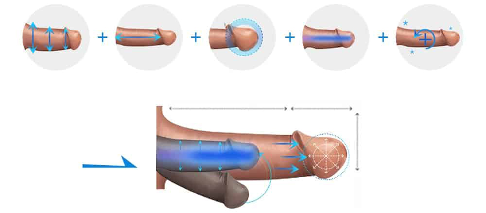 penis enlargement - ETERNITY CLINIC นพ.สืบพงษ์ เอ่งฉ้วน เพิ่มขนาดน้องชาย มีกี่แบบ