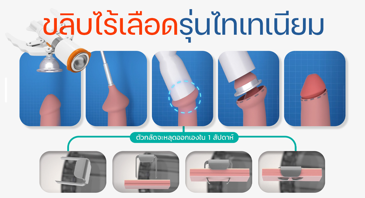 Staple Circumcision - ETERNITY CLINIC นพ.สืบพงษ์ เอ่งฉ้วน ขลิบไร้เลือดรุ่นไทเทเนียม