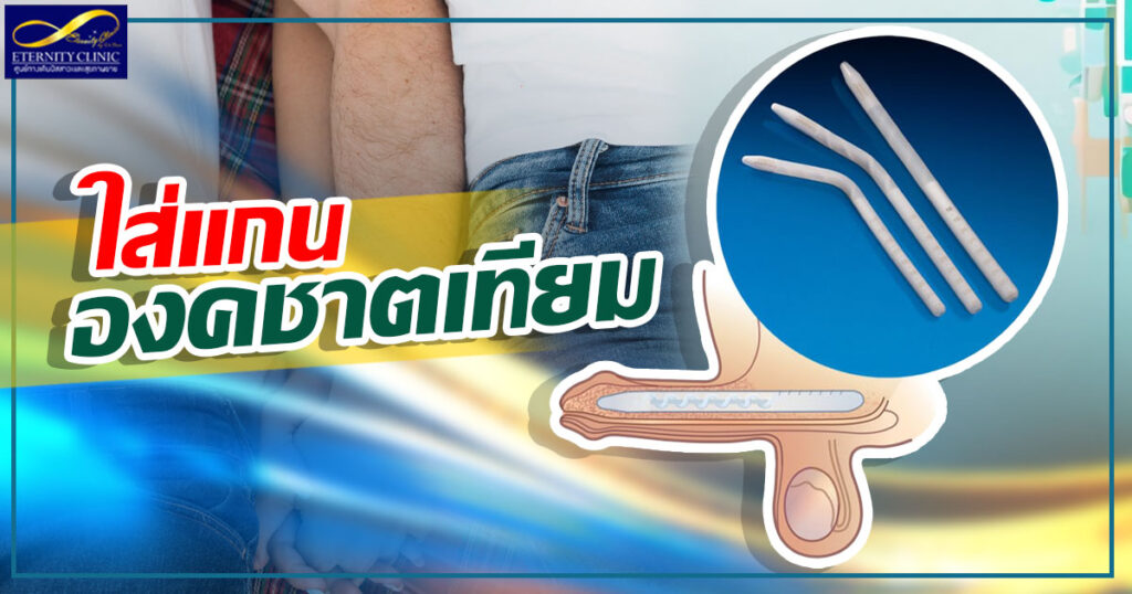 1. Put on the artificial penis. - ETERNITY CLINIC นพ.สืบพงษ์ เอ่งฉ้วน ใส่เเกนองคชาต