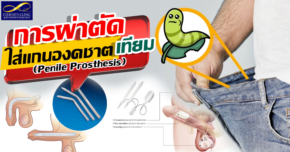 3.Surgery to insert a prosthetic penile shaft - ETERNITY CLINIC นพ.สืบพงษ์ เอ่งฉ้วน แกนองคชาตเทียม