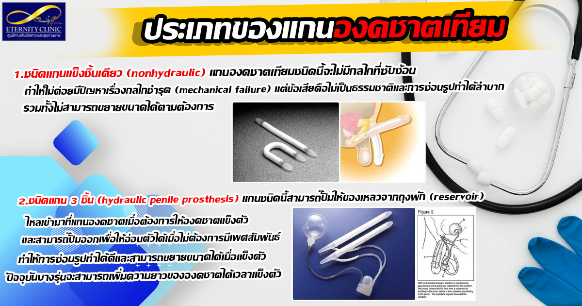4. Types of penile prostheses - ETERNITY CLINIC นพ.สืบพงษ์ เอ่งฉ้วน แกนองคชาตเทียม