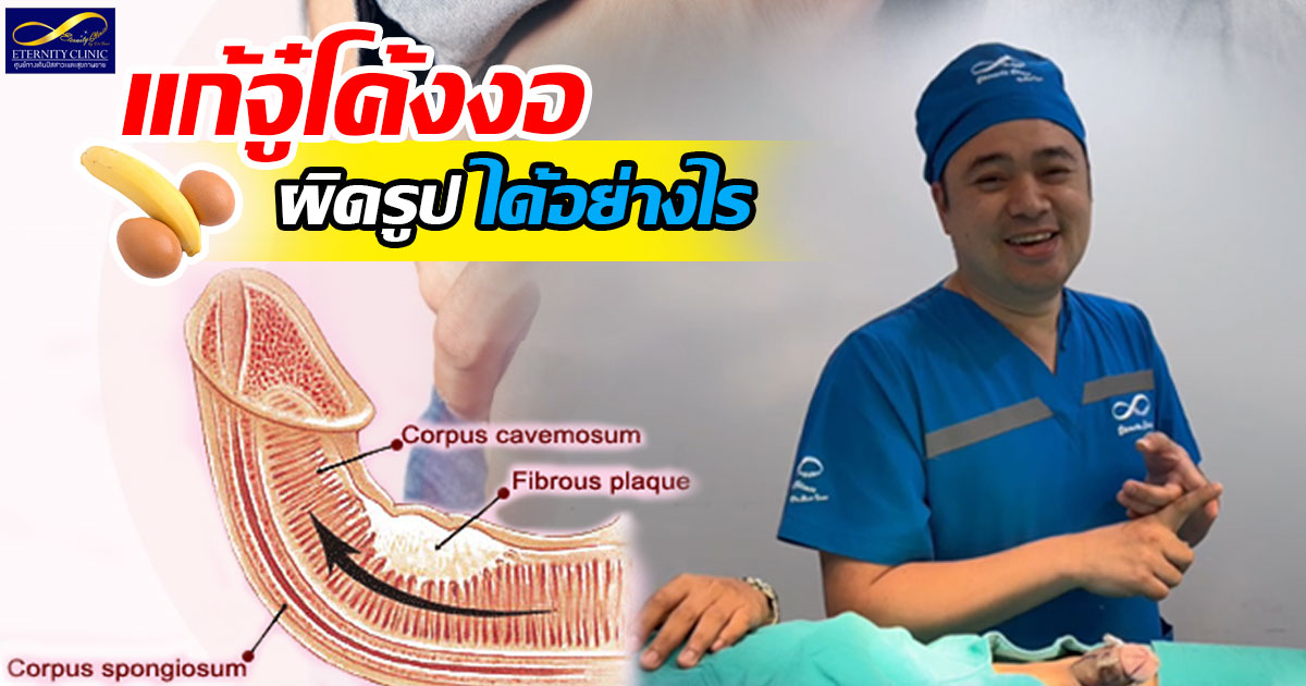 4.How to fix a curved, deformed penis - ETERNITY CLINIC นพ.สืบพงษ์ เอ่งฉ้วน อวัยวะเพศโค้งงอ