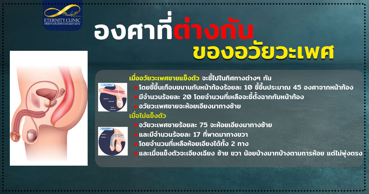 2. Different degrees of the penis - ETERNITY CLINIC นพ.สืบพงษ์ เอ่งฉ้วน อวัยวะเพศโค้งงอ องศาที่ต่างกัน หมอเบียร์ Eternity Clinic