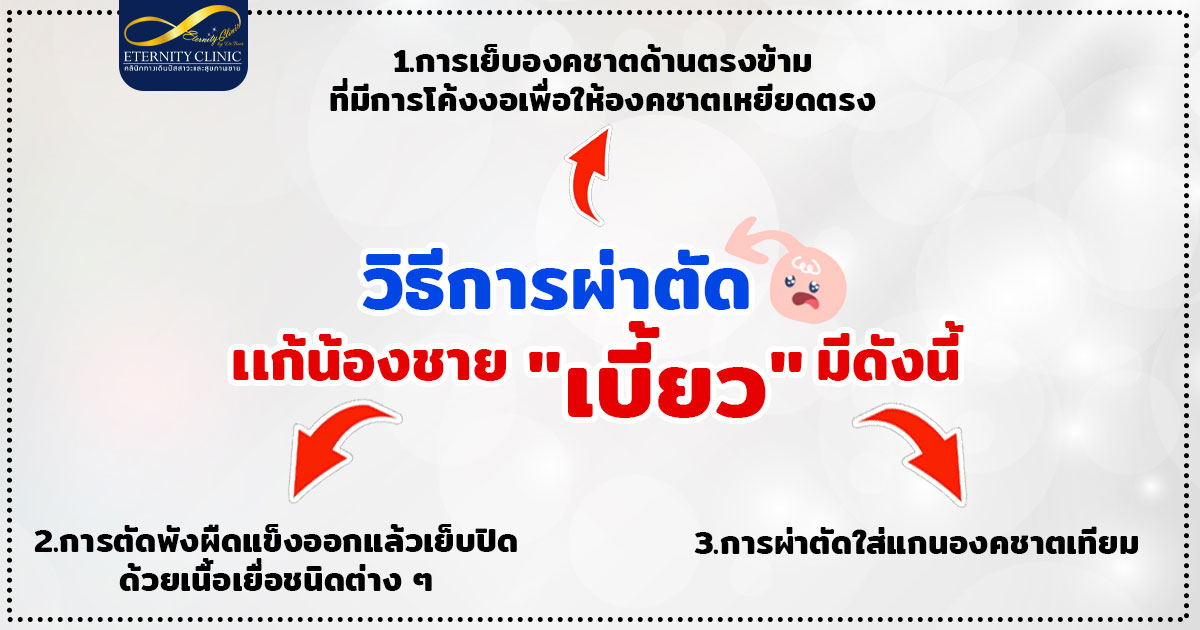 3. The surgical methods used may be as follows. - ETERNITY CLINIC นพ.สืบพงษ์ เอ่งฉ้วน วิธีการผ่าตัดแก้ น้องชายเบี้ยว 1.เย็นองคชาตด้านตรงข้าม 2.ตัดพังผืดออกแล้วเย็บ 3.ผ่าตัดใส่แกนเทียม