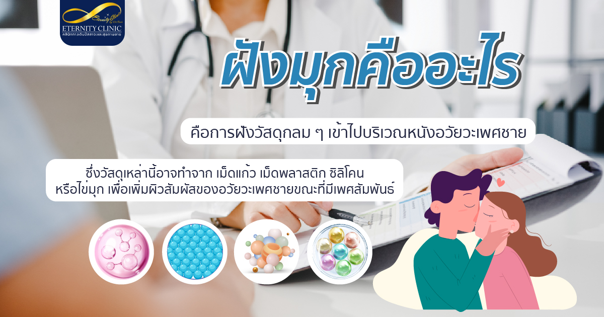 ฝังมุกคืออะไร