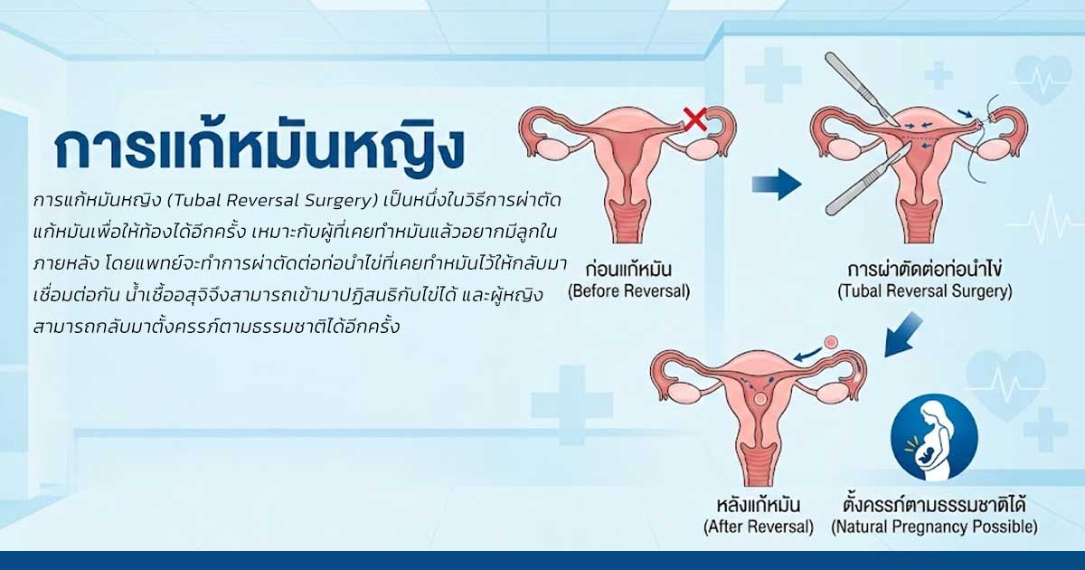 ed - ETERNITY CLINIC นพ.สืบพงษ์ เอ่งฉ้วน ผลข้างเคียงหลังทำหมัน