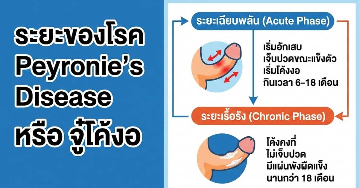 fvv - ETERNITY CLINIC นพ.สืบพงษ์ เอ่งฉ้วน แก้ไขจู๋โค้งงอ