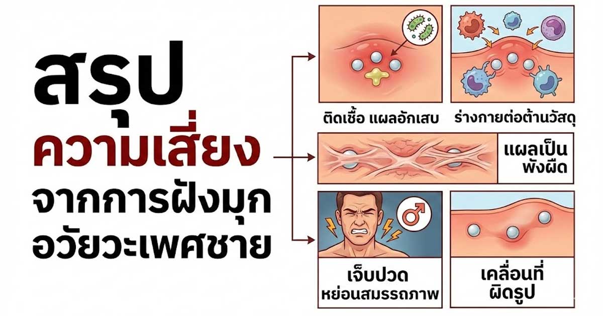 rfc - ETERNITY CLINIC นพ.สืบพงษ์ เอ่งฉ้วน สรุป ความเสี่ยงจากการฝังมุก