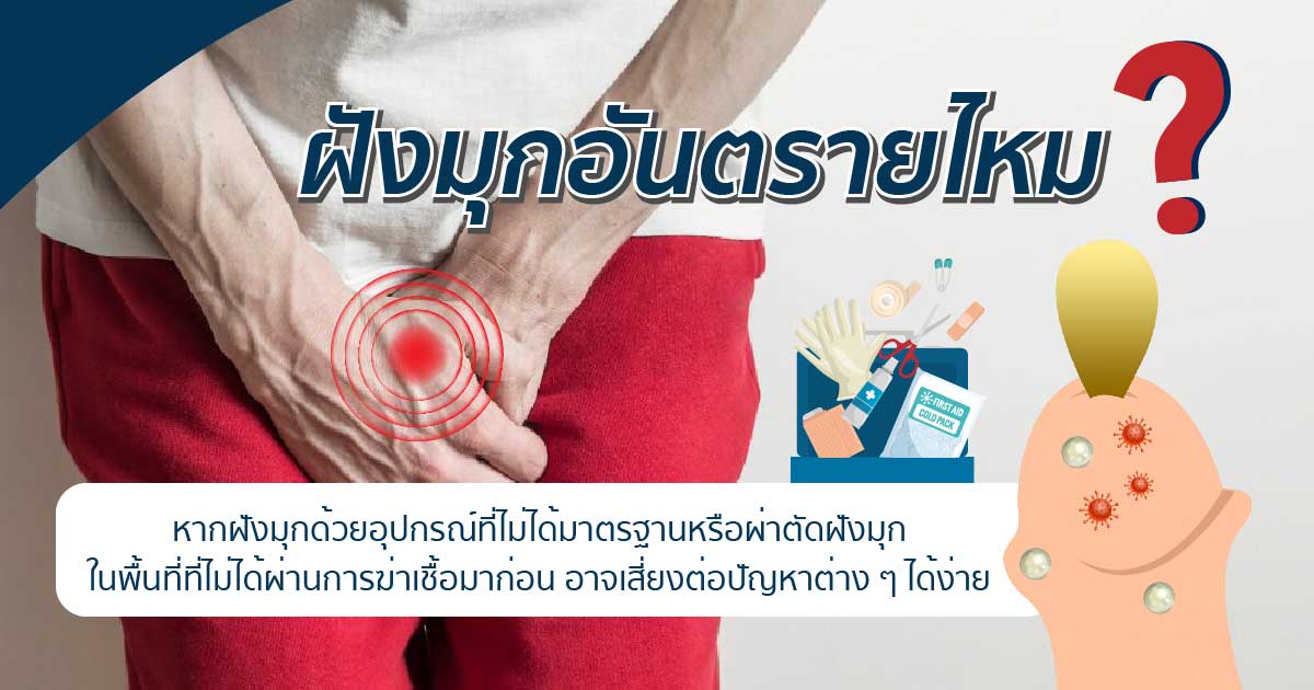 ddf - ETERNITY CLINIC นพ.สืบพงษ์ เอ่งฉ้วน พังผืดจากสิ่งแปลกปลอม/การฝังมุก