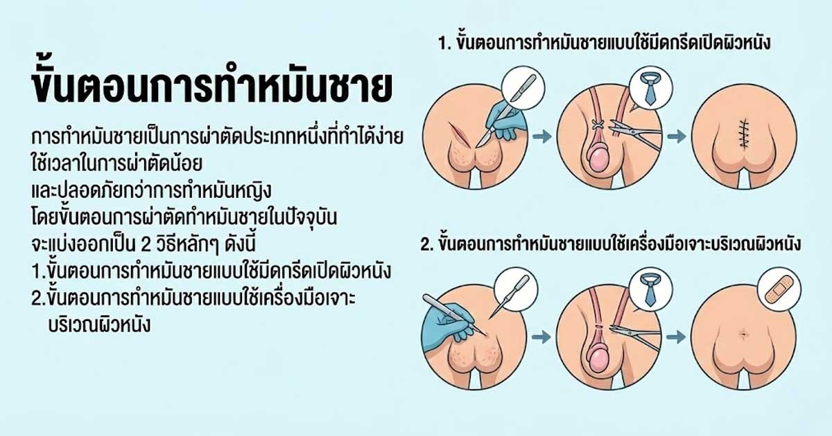dffz - ETERNITY CLINIC นพ.สืบพงษ์ เอ่งฉ้วน ขั้นตอนการทำหมันชาย
