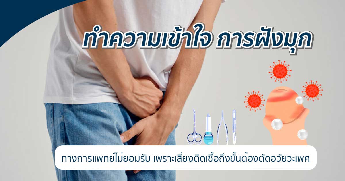 รีวิวฝังมุก