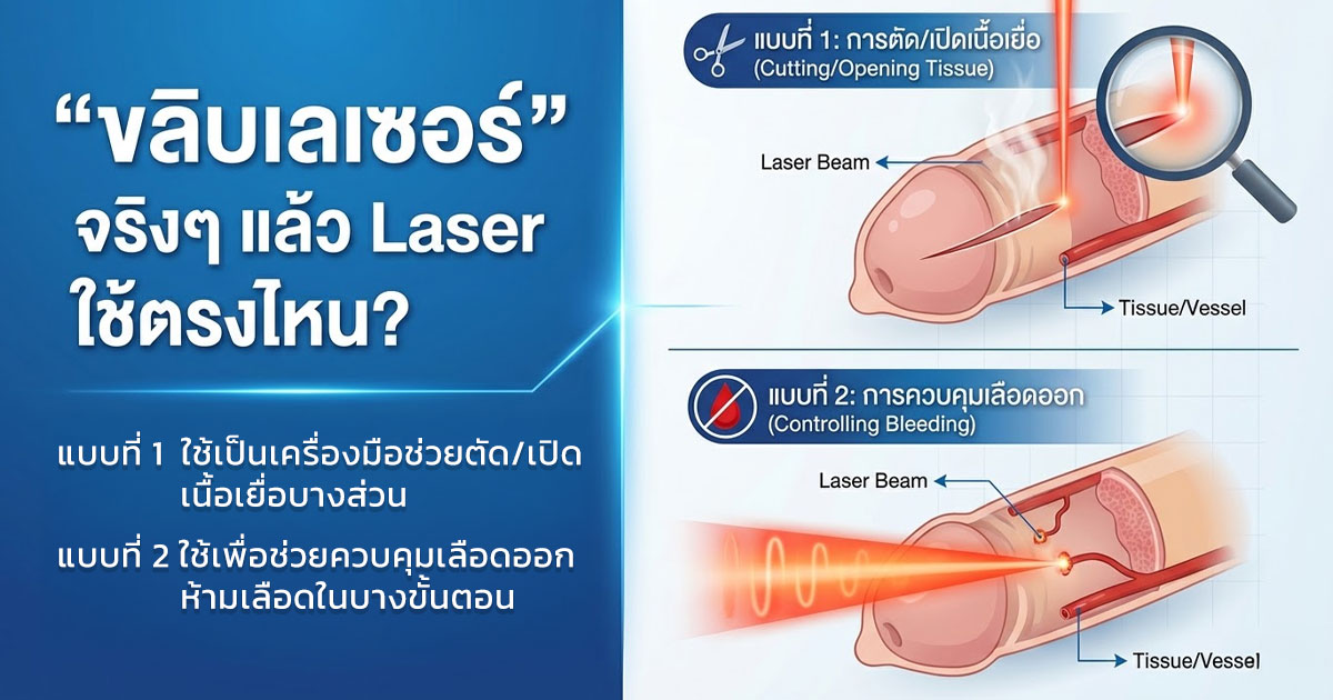 เลเซอร์ขลิบ