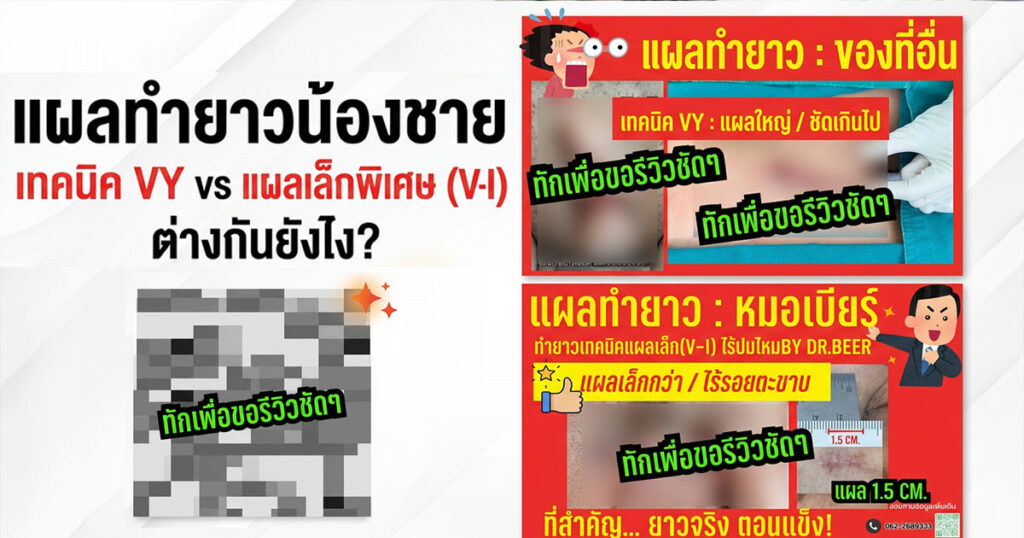 dffff - ETERNITY CLINIC นพ.สืบพงษ์ เอ่งฉ้วน เทคนิคเเผล VY