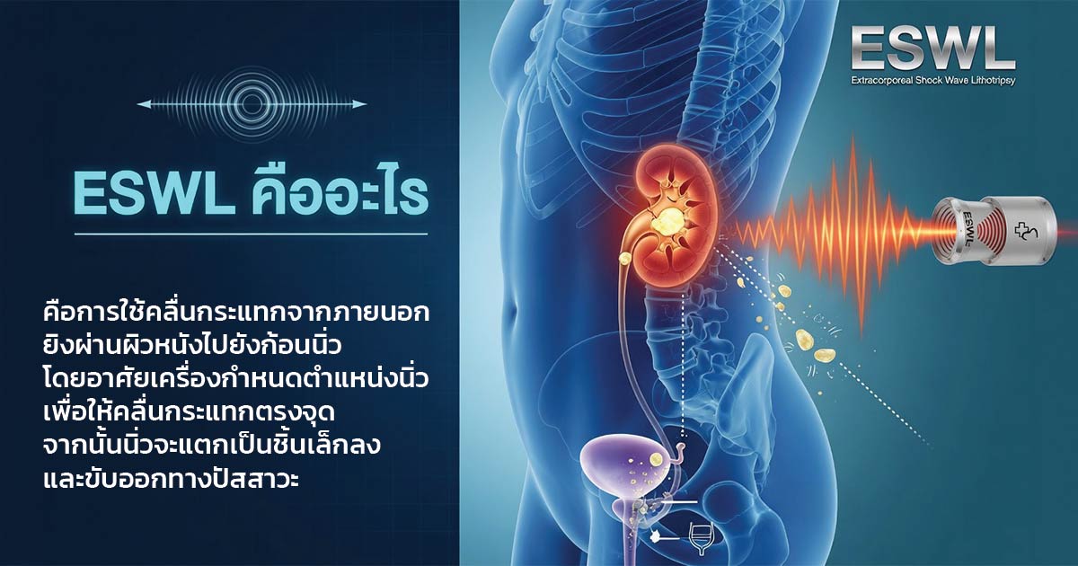 ESWL การสลายนิ่วด้วยคลื่นกระแทกจากภายนอก