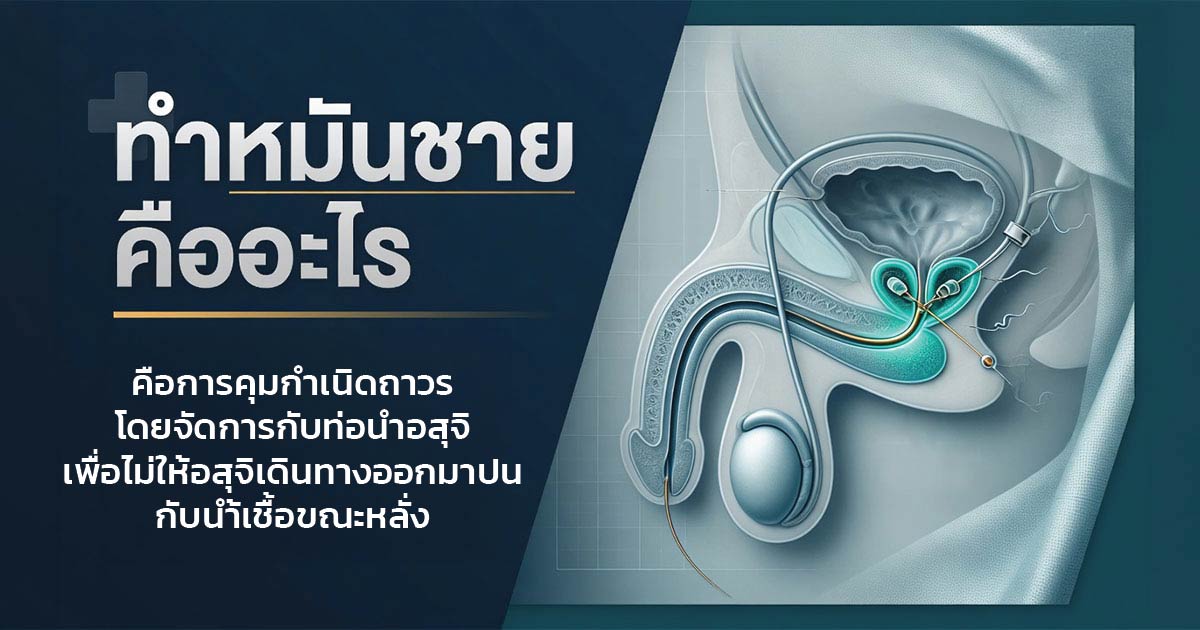 ทำหมันชายคือการปิดท่อนำอสุจิเพื่อคุมกำเนิดถาวร
