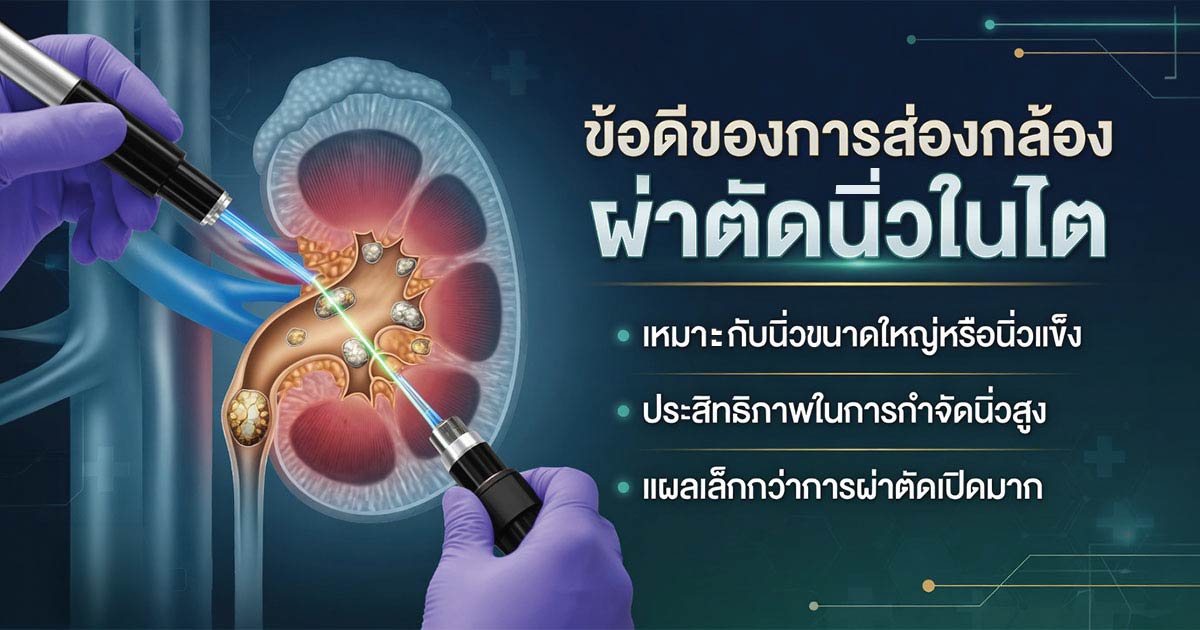 ข้อดีของการส่องกล้องผ่าตัดนิ่วในไต PCNL