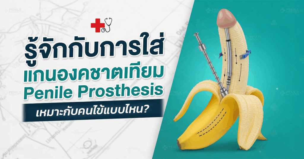 รู้จักกับการใส่แกนองคชาตเทียม Penile Prosthesis เหมาะกับคนไข้แบบไหน - ETERNITY CLINIC นพ.สืบพงษ์ เอ่งฉ้วน Penile Prosthesis