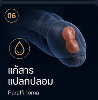 แก้สารแปลกปลอม Paraffinoma